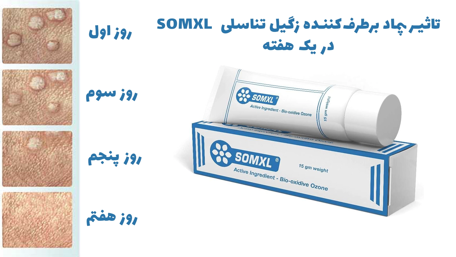 پماد برطرف‌کننده زگیل تناسلی  SOMXL