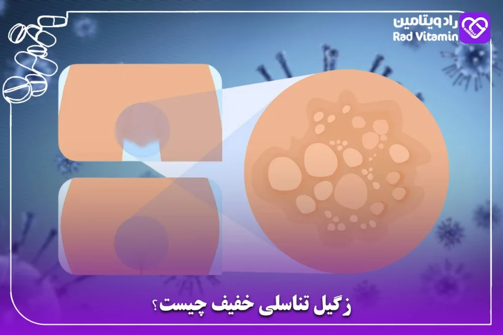 زگیل تناسلی خفیف