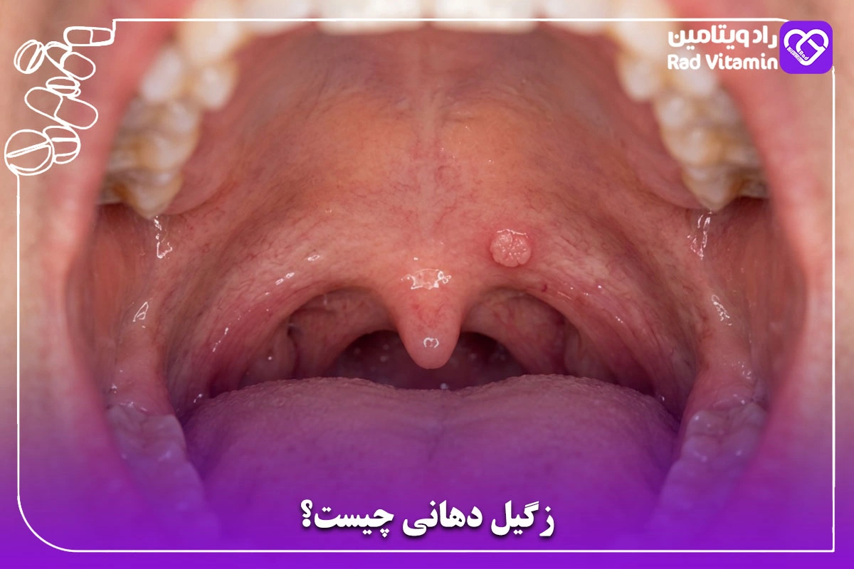 زگیل دهانی چیست؟