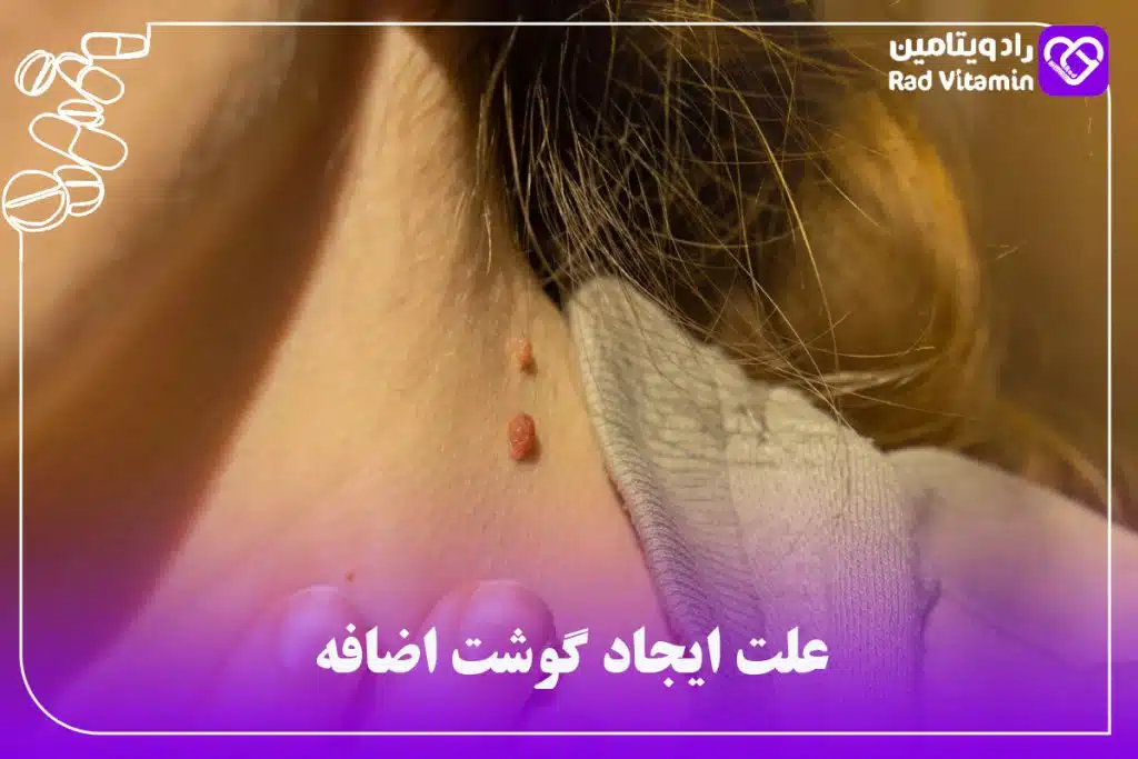 گوشت اضافه