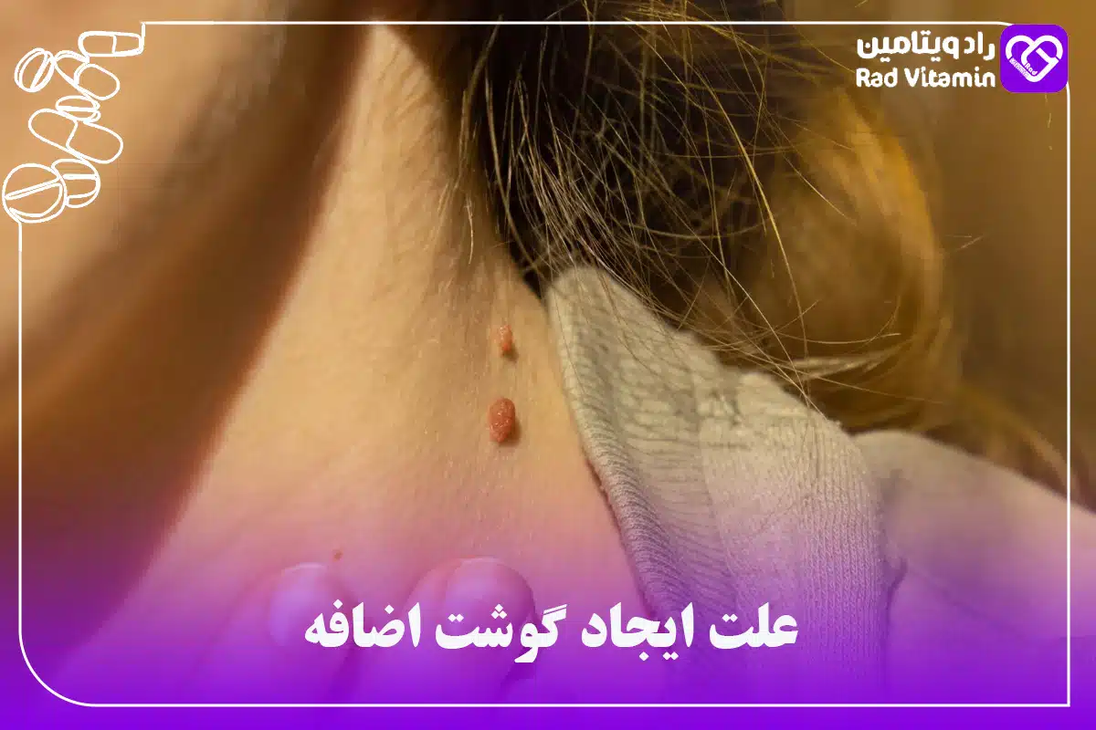 گوشت اضافه