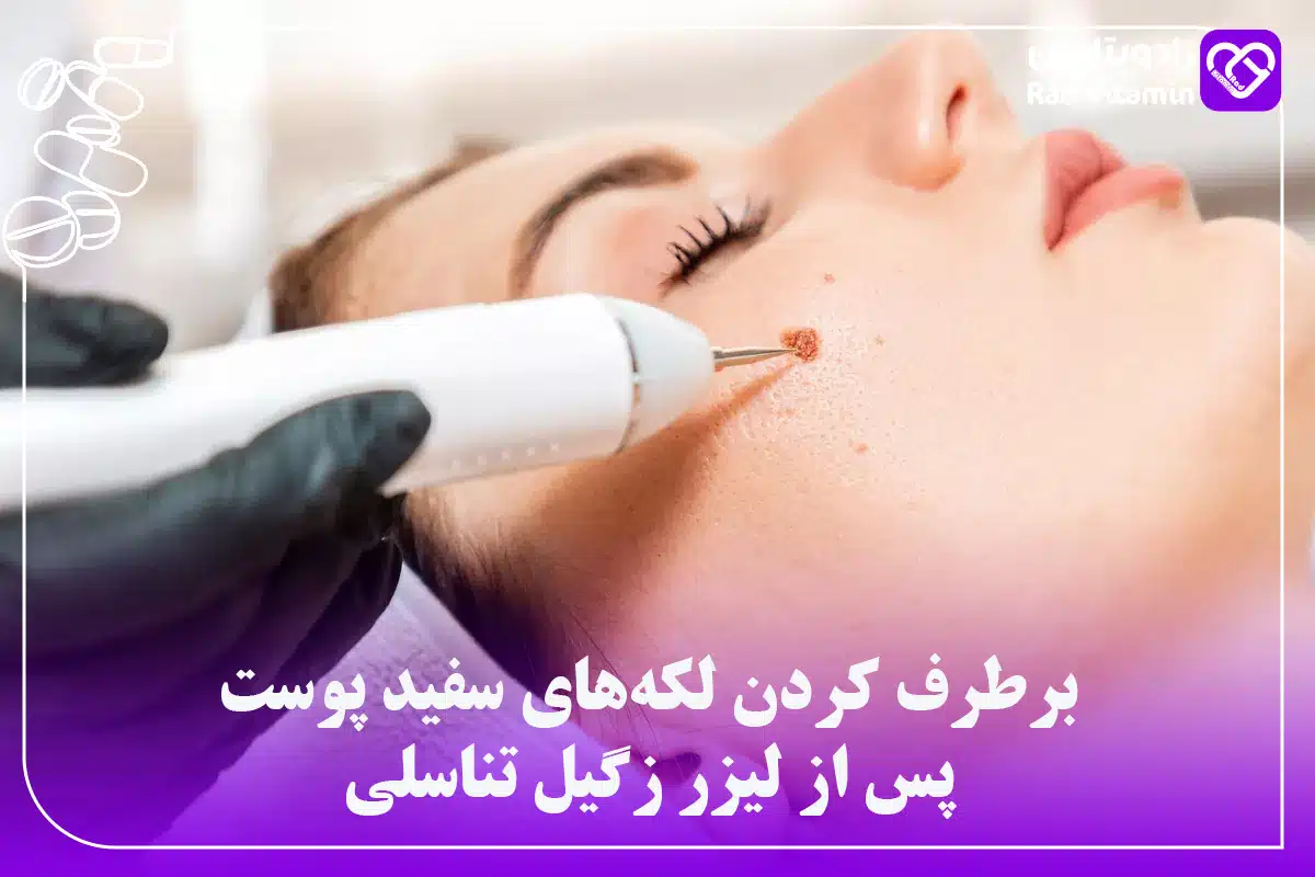 برطرف کردن لکه‌های سفید پوست پس از لیزر زگیل تناسلی