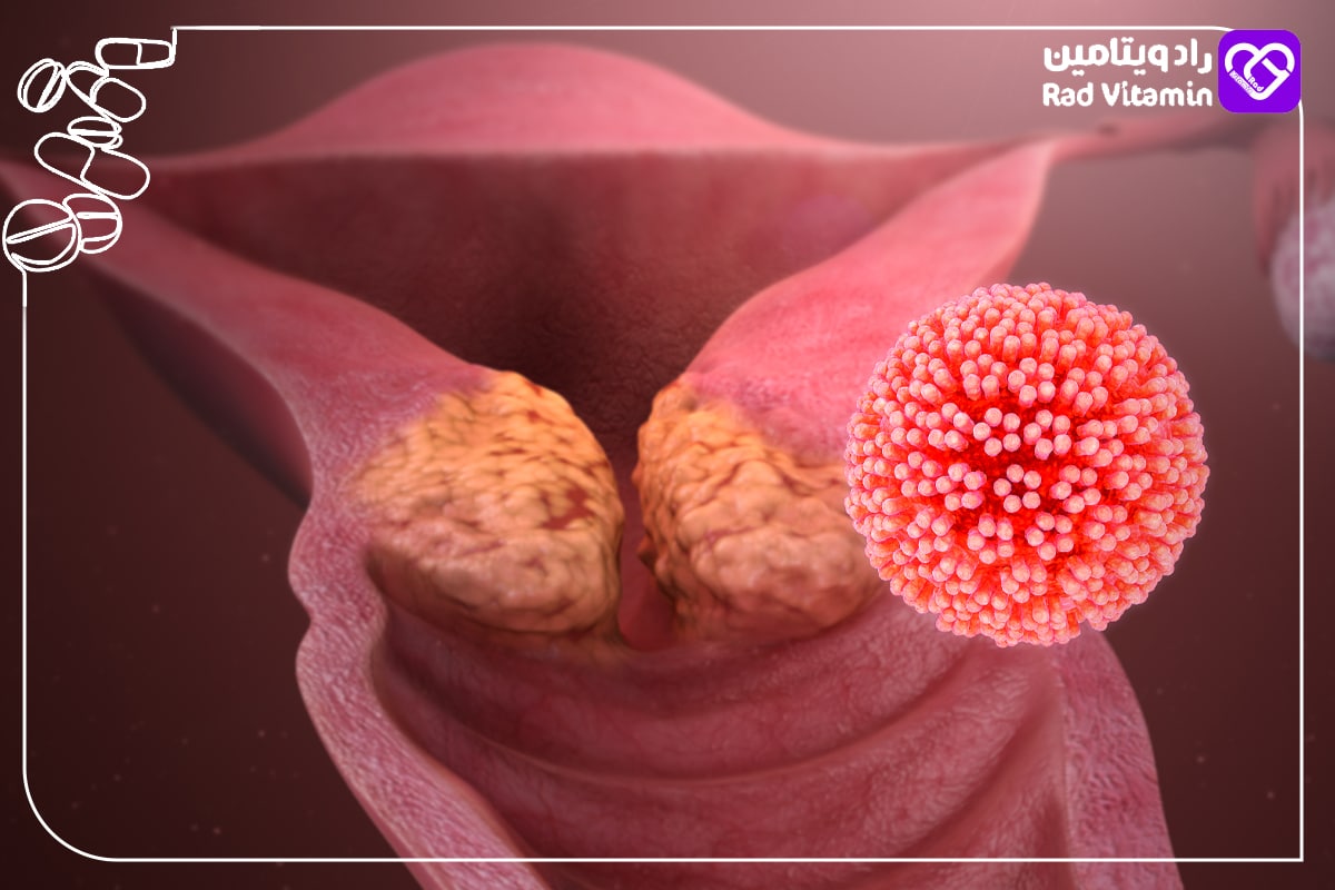 نقش HPV در بروز سرطان آلت تناسلی و واژن