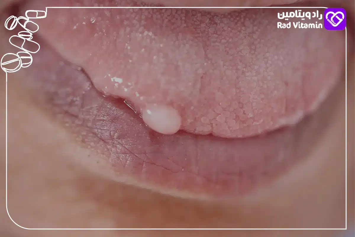 زگیل دهانی چیست؟ (4 روش درمان زگیل دهانی) 3 دلایل ابتلا به زگیل دهانی