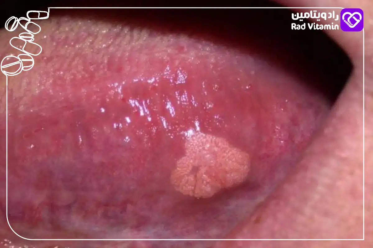 زگیل دهانی چیست؟ (4 روش درمان زگیل دهانی) 4 راههای انتقال زگیل دهانی