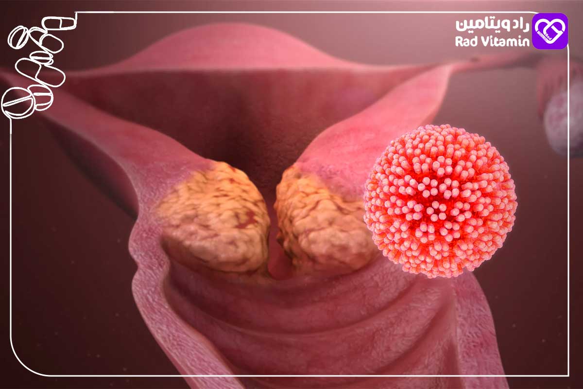 سرطان دهانه رحم در زنان 