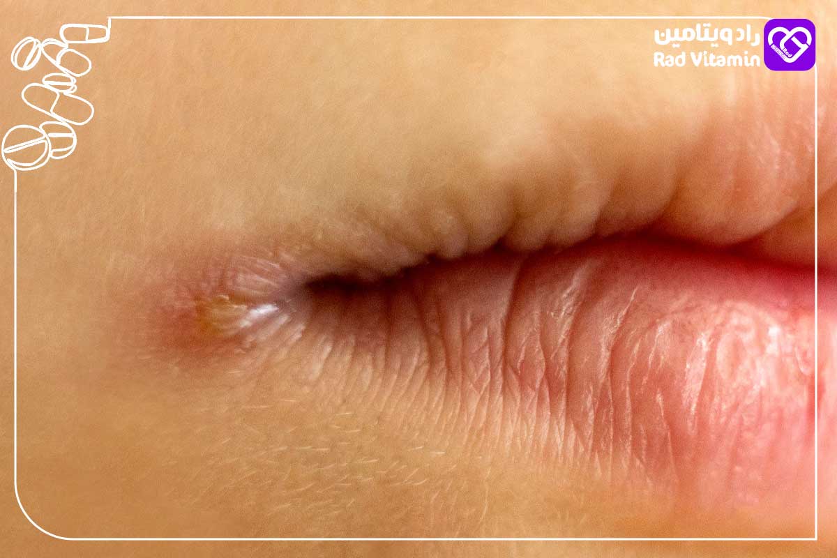 آیا زخم شدن گوشه لب میتواند نشانه زگیل تناسلی باشد؟ 6 درمان زخم شدن گوشه لب
