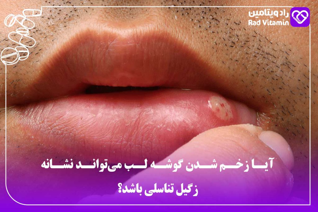 زخم شدن گوشه لب