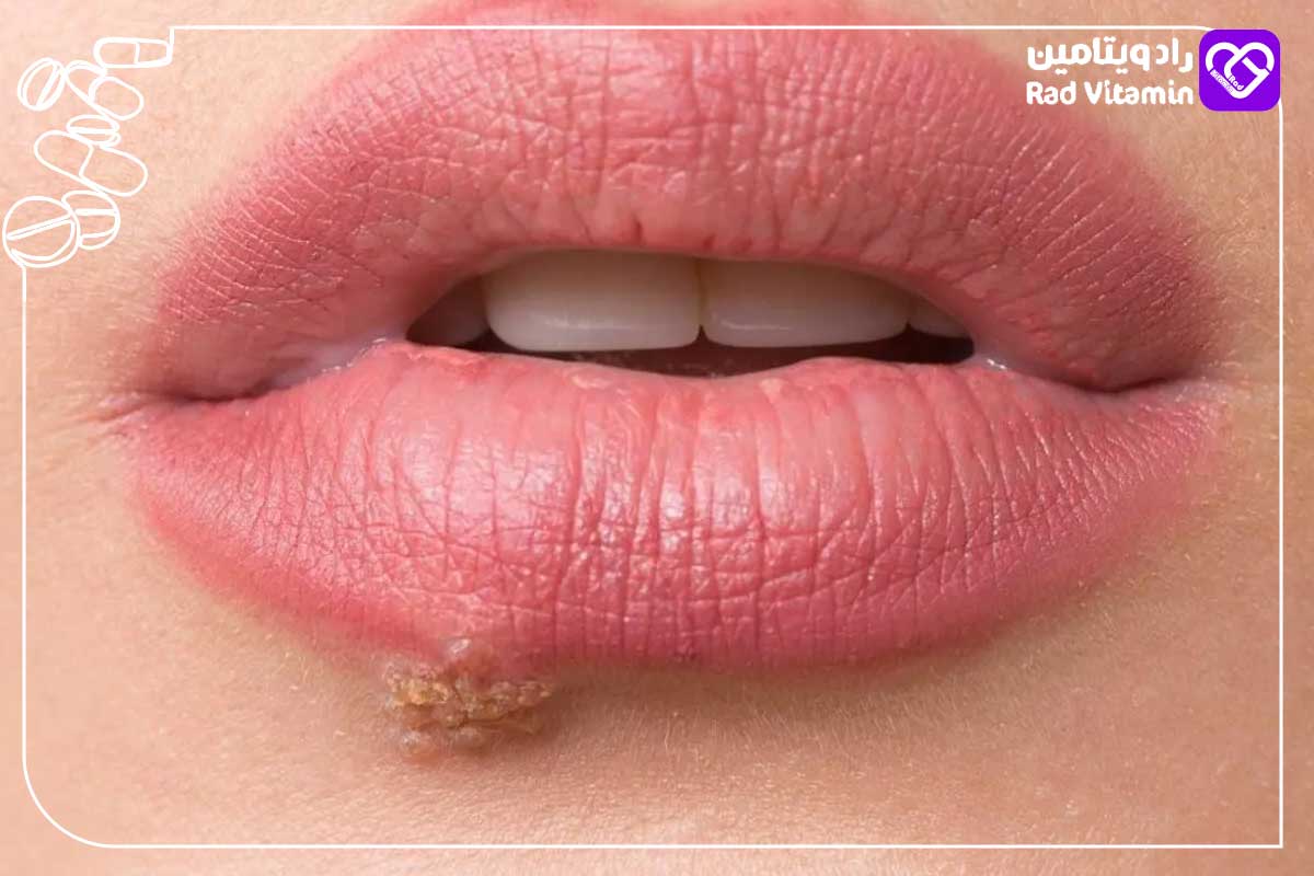آیا زخم شدن گوشه لب میتواند نشانه زگیل تناسلی باشد؟ 3 زگیل روی لب