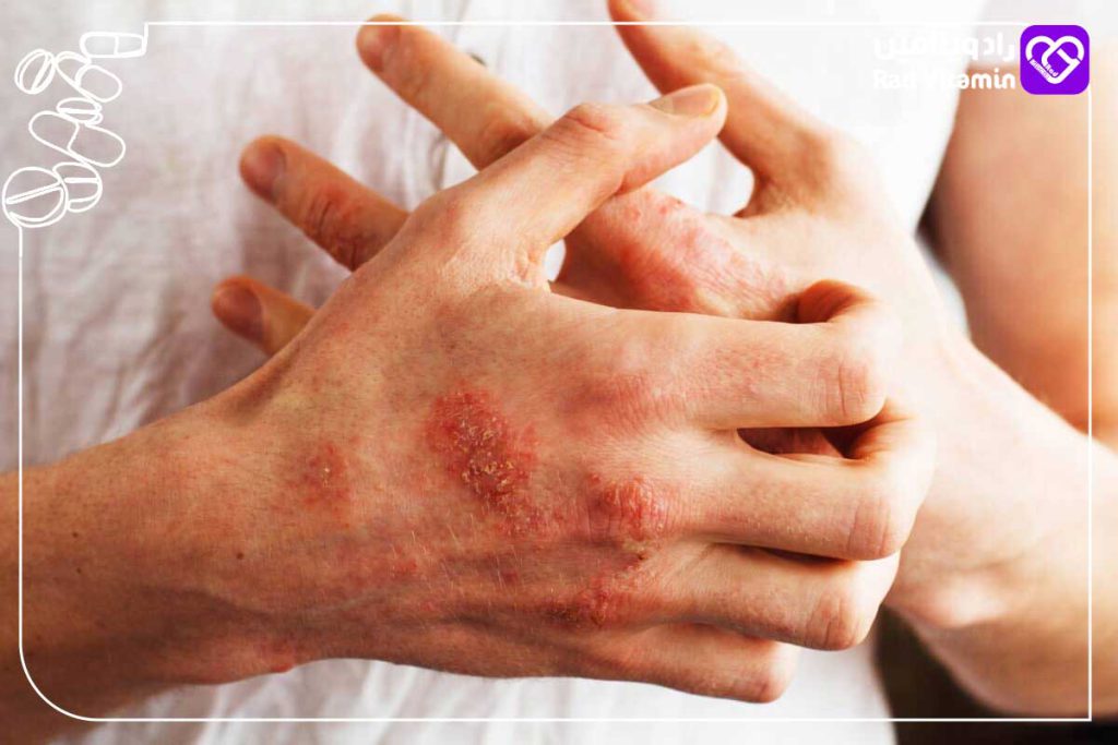 بیماری‌های خودایمنی