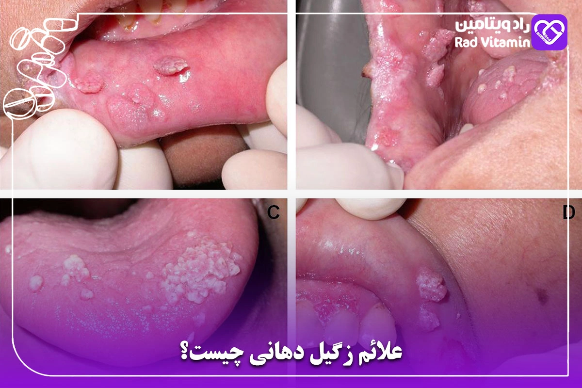 علائم زگیل دهانی چیست؟
