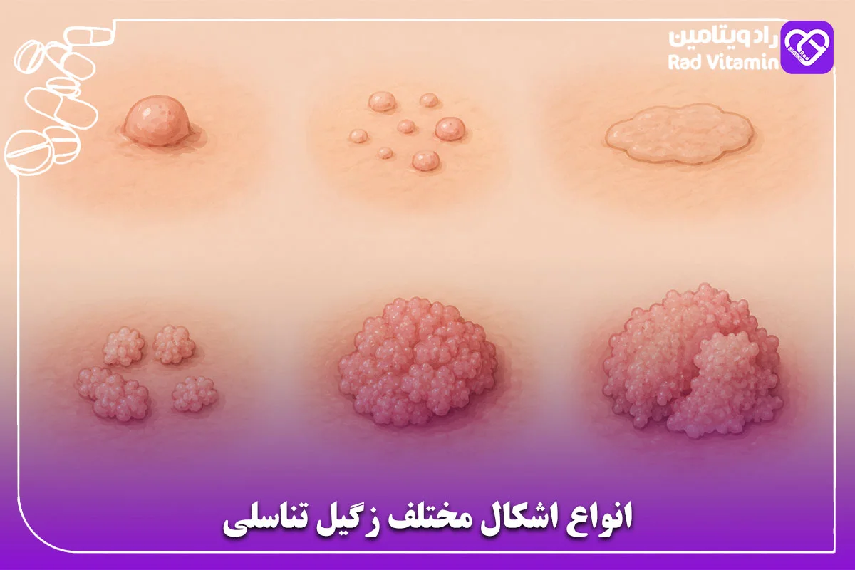 انواع اشکال مختلف زگیل تناسلی